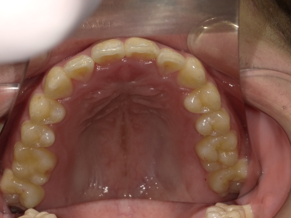 症例集　インビザライン　上顎