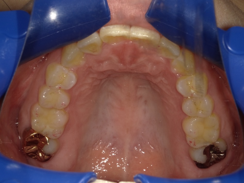 症例集　インビザライン　上顎