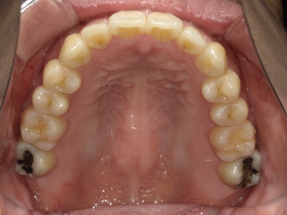 症例集　インビザライン　上顎