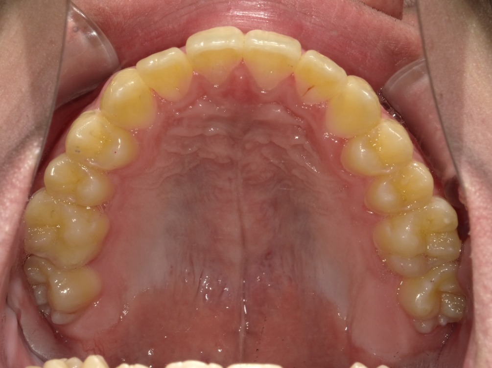 症例集　インビザライン　上顎