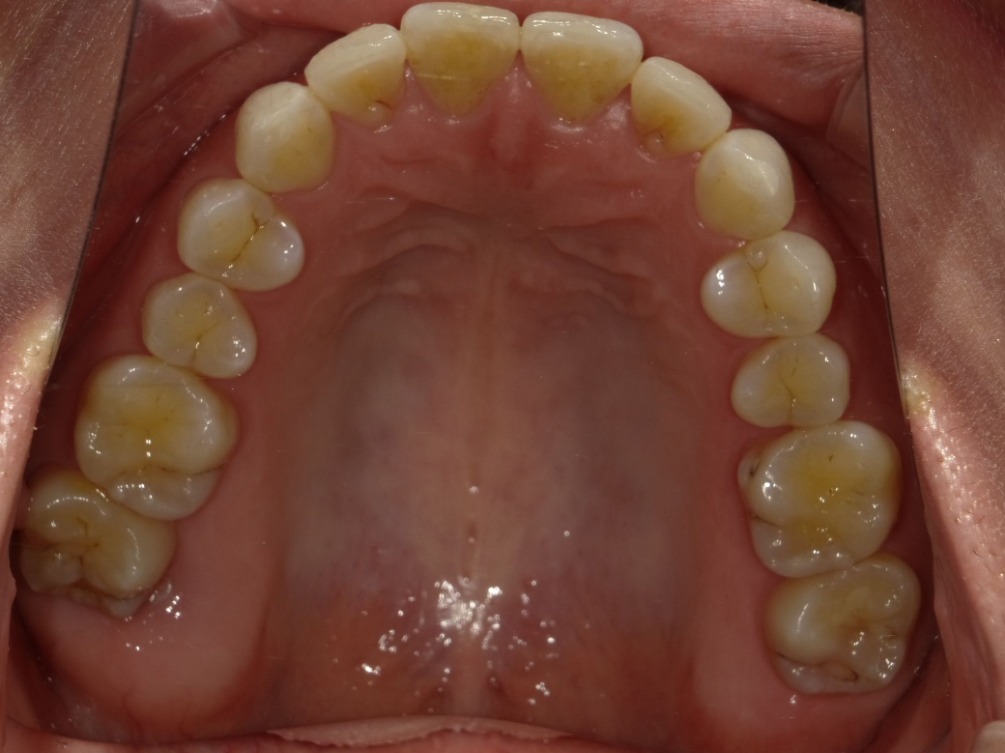 症例集　インビザライン　上顎