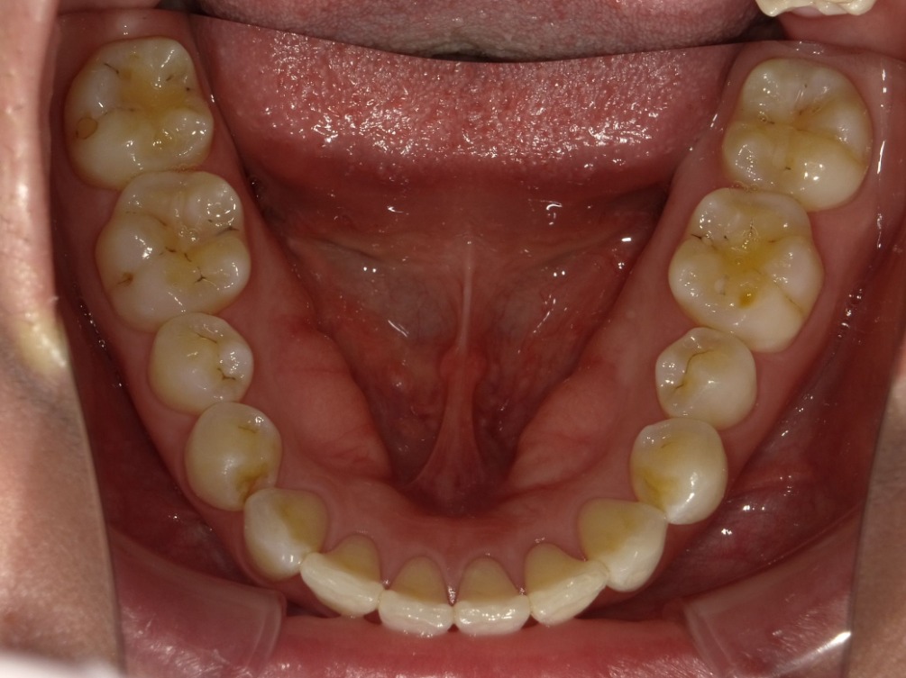 症例集　インビザライン　下顎