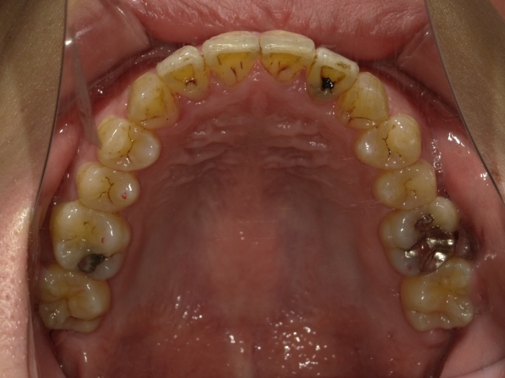 症例集　インビザライン　上顎