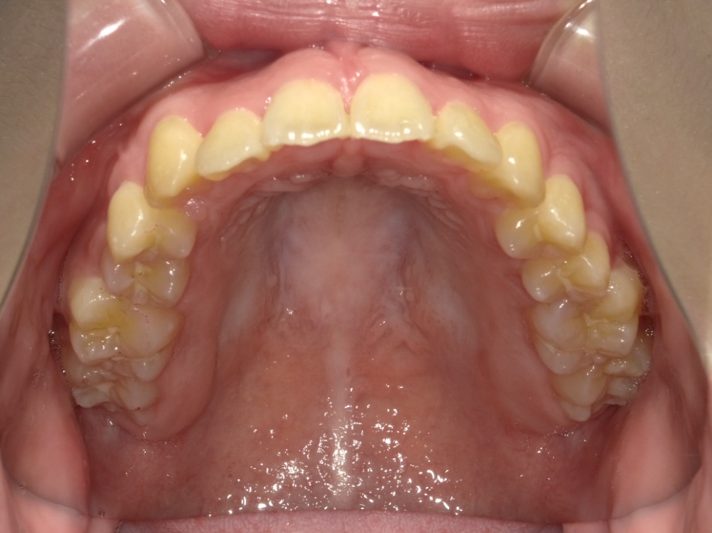 症例集　インビザライン　上顎