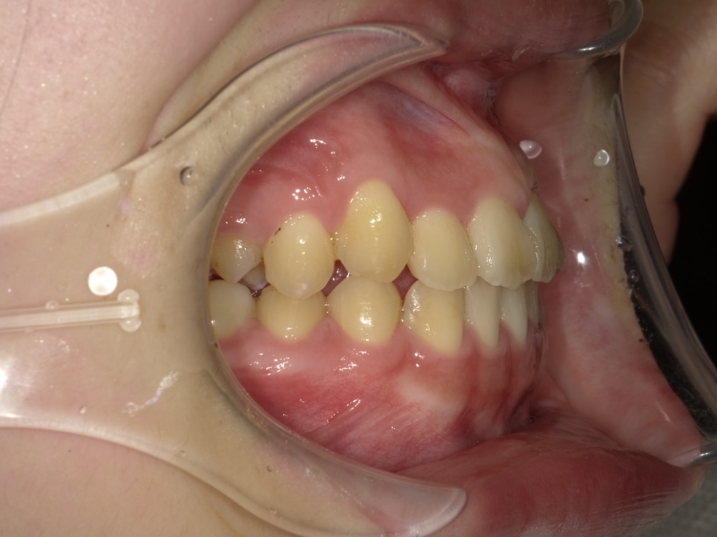 症例集　インビザライン　右横