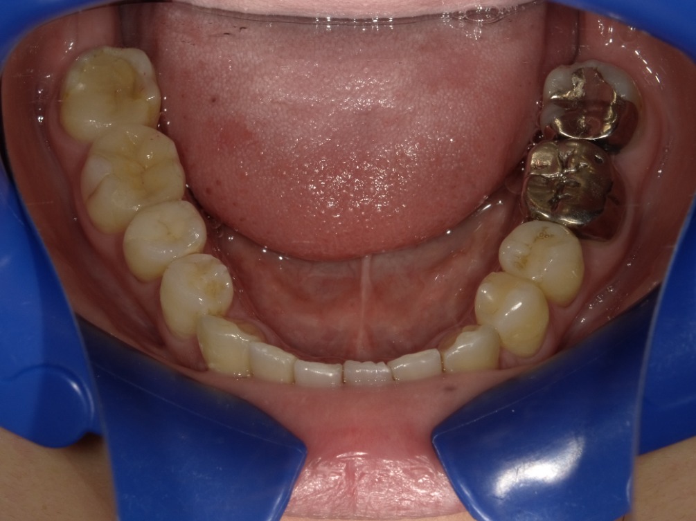 症例集　インビザライン　下顎