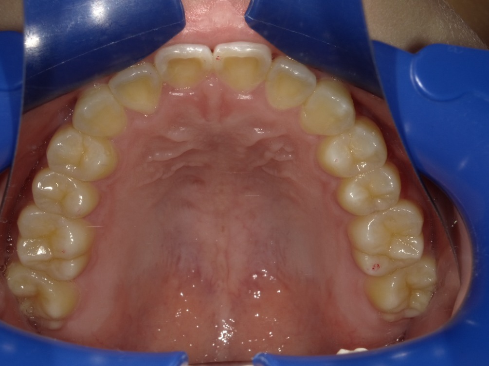 症例集　インビザライン　上顎