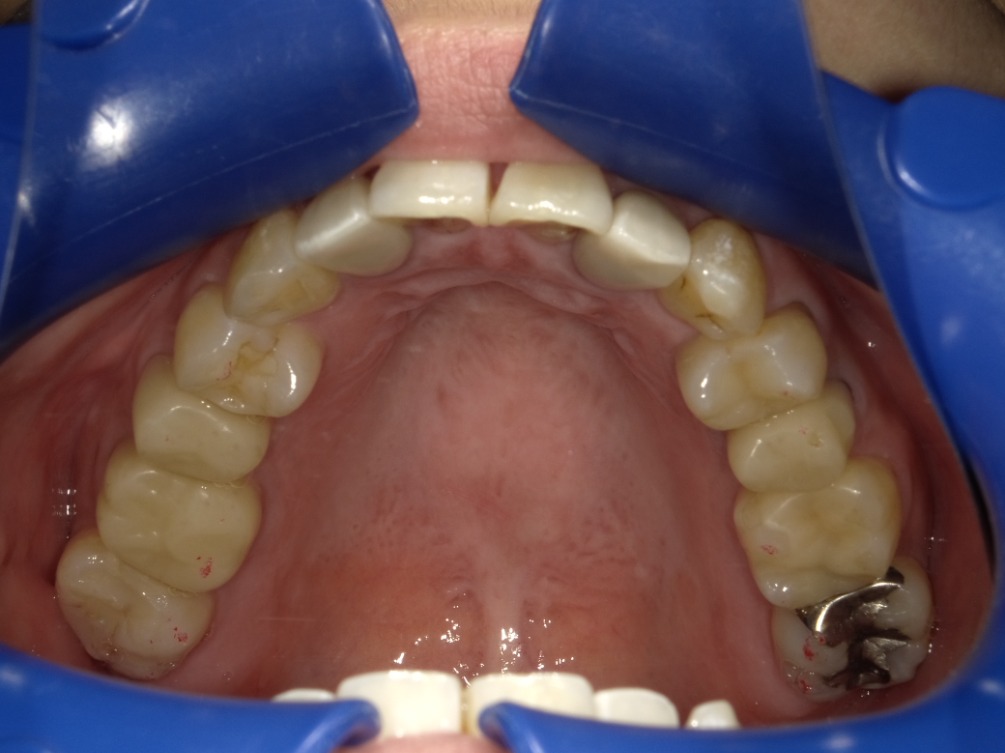 症例集　インビザライン　上顎
