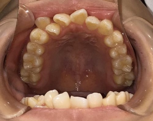 症例集　インビザライン　上顎