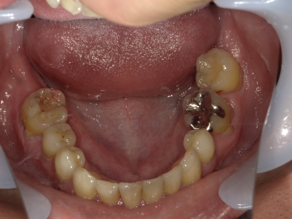 症例集　インビザライン　下顎