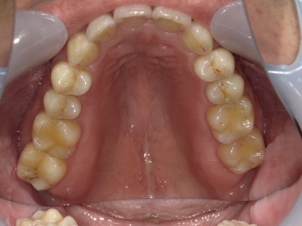 症例集　インビザライン　上顎