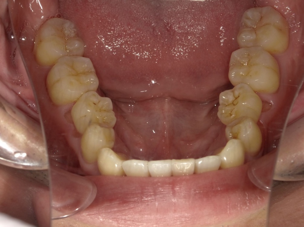 症例集　インビザライン　下顎