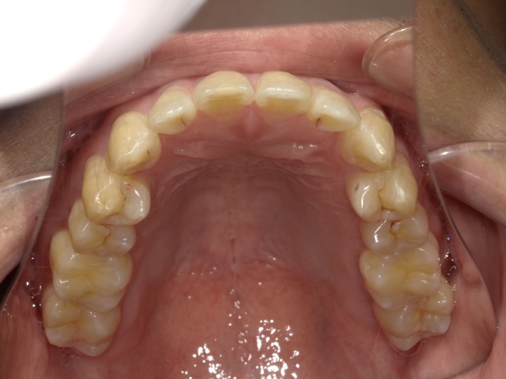 症例集　インビザライン　上顎