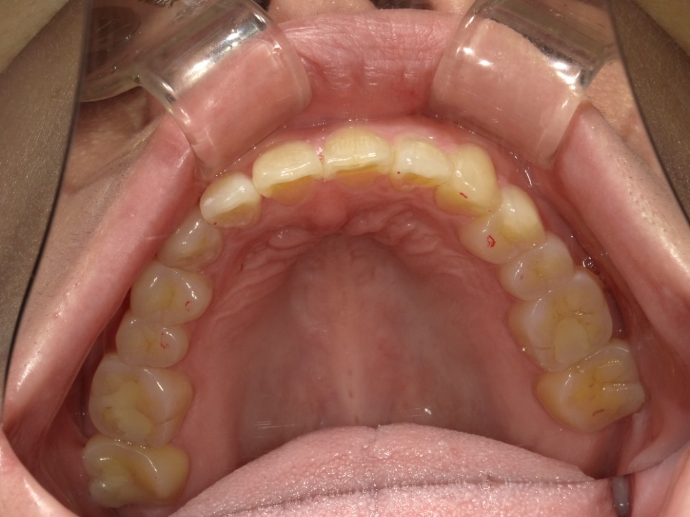 症例集　インビザライン　上顎