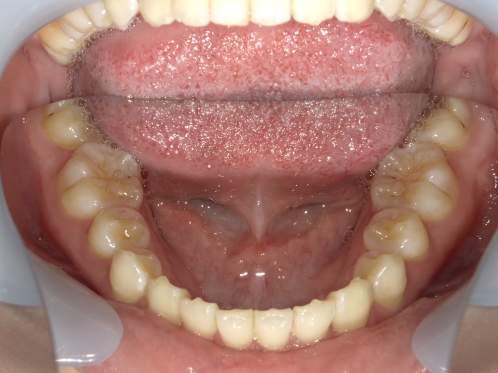 症例集　インビザライン　下顎