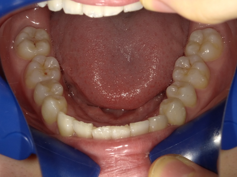 症例集　インビザライン　下顎